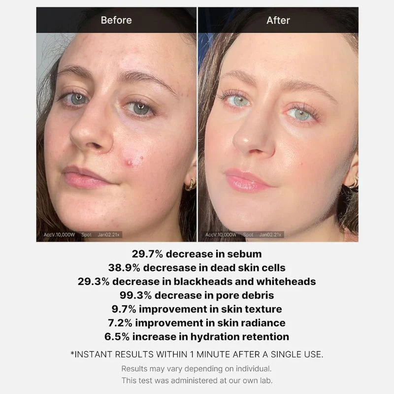 Medicube Red Acne Succinic Acid Peel